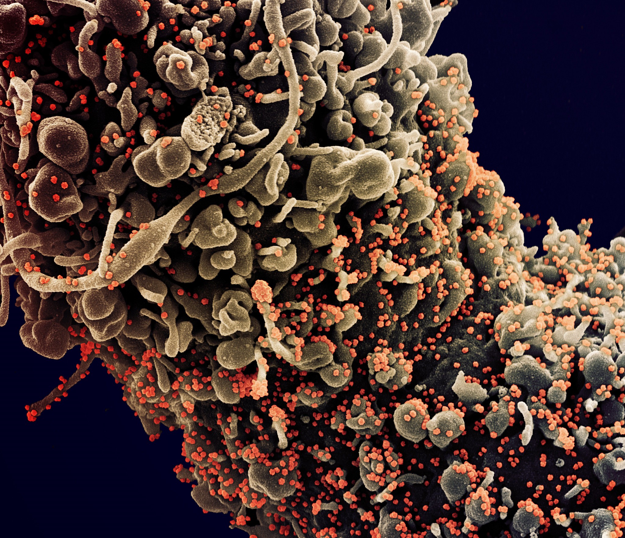 Novo SARS-CoV-2 de Coronavírus Micrografia eletrônica de varredura colorida de uma célula mostrando sinais morfológicos de apoptose, infectados com partículas do vírus SARS-COV-2 (laranja), isoladas de uma amostra de paciente. Imagem capturada no NIAID Integrated Research Facility (IRF) em Fort Detrick, Maryland. Crédito: NIAID